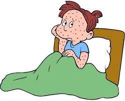 chickenpox 